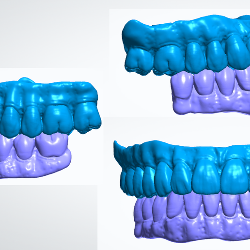 Maxillary & Mandibular All on X 3D model