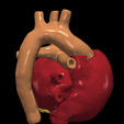 13.png 3D Model of Transposition of the Great Arteries Open Duct