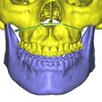 Osteotomia_1.jpg cas de chirurgie orthognathique avec guides et segmentations