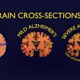 ps16.jpg Alzheimer Disease Brain coronal slice