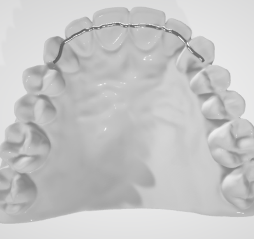 High resolution Fix Lingual Retainer Dental Appliance