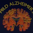 ps22.jpg Alzheimer Disease Brain coronal slice