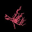 9.jpg 3D Model of Middle Cerebral Artery (MCA) Aneurysm