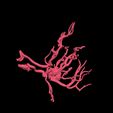 9.jpg 3D Model of Middle Cerebral Artery (MCA) Aneurysm
