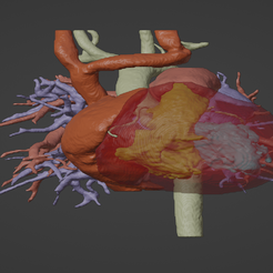 1.png 3D Model of Human Heart with Ventricular Septal Defect (VSD)