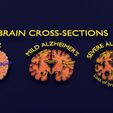 ps15.jpg Alzheimer Disease Brain coronal slice