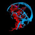 i9.jpg 3D Model of Brain Arteriovenous Malformation