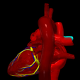4.png 3D Model of Partial Anomalous Pulmonary Venous Connection