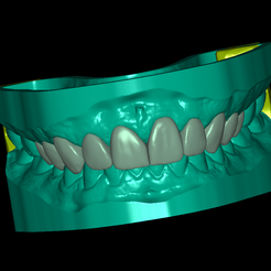front.png STL-Datei Zahnmodell mit 10 Veneers und Artikulator・3D-druckbares Modell zum Herunterladen