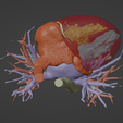 6.png 3D Model of Human Heart with Tetrology of Fallot (TOF) - generated from real patient
