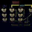 pelvis-fracture-classifications-3d-model-blend-5.jpg Pelvis fracture classifications 3D model
