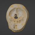w13.png 3D Model of Middle Cerebral Artery (MCA) Aneurysm