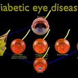 dm0001.jpg Diabetic eye diseases model