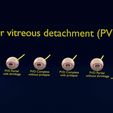 posterior-vitreous-detachment-types-eye-3d-model-blend-82.jpg Posterior vitreous detachment types eye 3D model