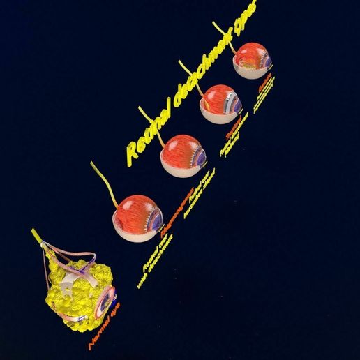 retinal-detachment-types-eye-3d-model-blend-73.jpg Retinal detachment types eye 3D model
