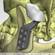 prosthetic-1.jpeg Individual TMJ prosthesis (real operation)