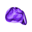 ArticularFossaLeft.stl Individual TMJ prosthesis (real operation)