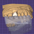 Captura-de-pantalla-2023-06-25-134939.png Dental Crown + Scanned Models