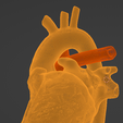 28.png 3D Model of Heart after Fontan Procedure