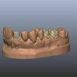 Capture.jpg STL file Dental Model Master with Dies 11 15 16・3D printer design to download