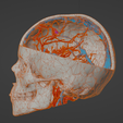 uv2.png 3D Model of Brain Arteriovenous Malformation