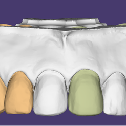 MODELO.png STL file DENTAL VENEER - DENTAL VENEERS・3D print design to download