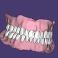 Capture.png Upper and lower full dentures. Teeth and bases