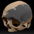 Skull.jpg Cranial plate made according to anthropometric data (an interesting case)