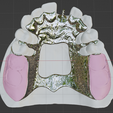 Kennedy-Class-I-Mod-1-Maxillary-6.png Prosthodontics Kennedy Class I Mod 1 Maxillary Removable partial denture (RPD)