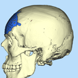 3.png CRANIAL PLATE MADE ACCORDING TO DEFECT