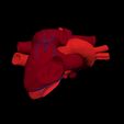 i7.jpg 3D Model of Heart with Atrial Septal Defect