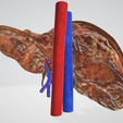 fibrotic-LIVER,-abdominal,-abdomen,-spleen,-pancreas,-pancreatic,-biliary,-hepatic,-artery,-vein,-po.png 6 PIÈCES Modèle 3D réaliste du foie atteint de cirrhose (fibrose) - avec système biliaire, veines portales, veines et artères hépatiques, ligaments du foie