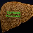 ps11.jpg 3D Alchoholic liver disease cirrhosis hepatitis fatty model