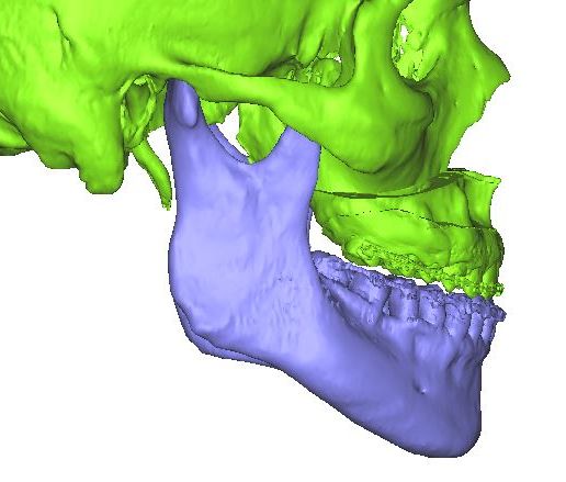 Movimiento_Anterior_5mm_1.jpg cas de chirurgie orthognathique avec guides et segmentations