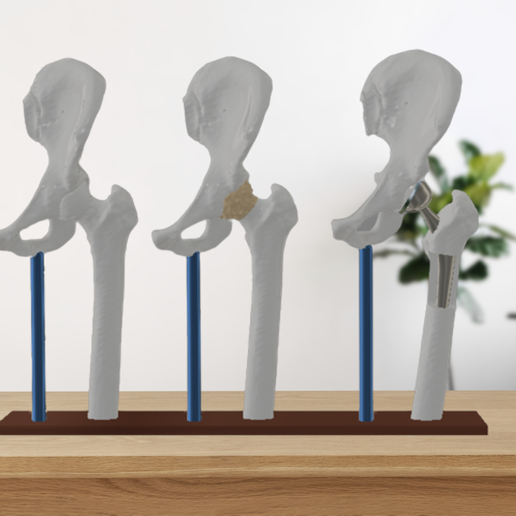 Hip Replacement 3D model