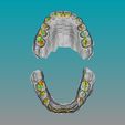 Occlusion Coco) Col) Contact Strong ONT i o-le AIAN stli4 BOTH MAXILLARS - SUPERIOR and INFERIOR intraoral scan (IOS) - AREA3D - Patient A. Complete DENTURE