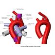 ARSA-V2-01.jpg Aberrant right subclavian artery anomaly 3D print model