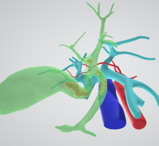 bile-duct-stone-biliary-gall-5.png Calcul du canal cholédoque