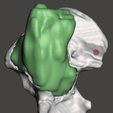 Preview3.png Sarcoma pélvico impreso en 3D