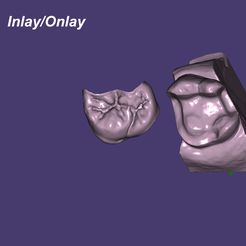 inlay.jpg STL-Datei Dental Inlay with model・Design zum Herunterladen und 3D-Drucken