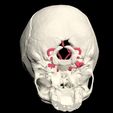 3.jpg 3D Model of Middle Cerebral Artery (MCA) Aneurysm