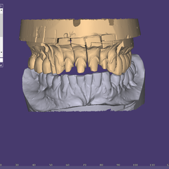 bimax.png dental prosthesis