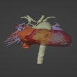 1.png 3D Model of Human Heart with Common Arterial Trunk (CAT) - generated from real patient