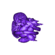 Dextro Cardia.stl 先天性心脏病分类（CHD）