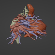 8.png 3D Model of Human Heart with Ventricular Septal Defect (VSD)