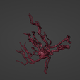 t8.png 3D Model of Middle Cerebral Artery (MCA) Aneurysm