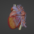 3.png 3D Model of Human Heart with Anomalous Pulmonary Venous Drainage (APVC) - generated from real patient
