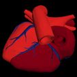 i4.jpg 3D Model of Heart with Atrial Septal Defect