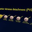 posterior-vitreous-detachment-types-eye-3d-model-blend-43.jpg Posterior vitreous detachment types eye 3D model