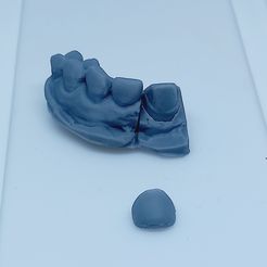 20211201_231314.jpg STL file Veneer with demountable die・3D print object to download